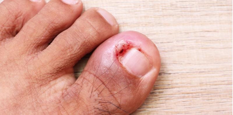 Tak Tahan Rasa Sakit Kuku Cengkam? Ini Tanda Anda Perlu Jalani Pembedahan Kuku!