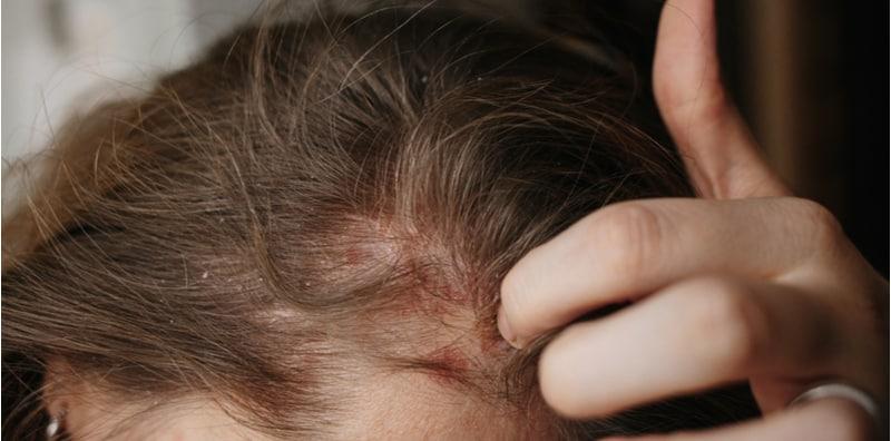 Kelemumur Punca Masalah Keguguran Rambut? Ini Jawapannya!