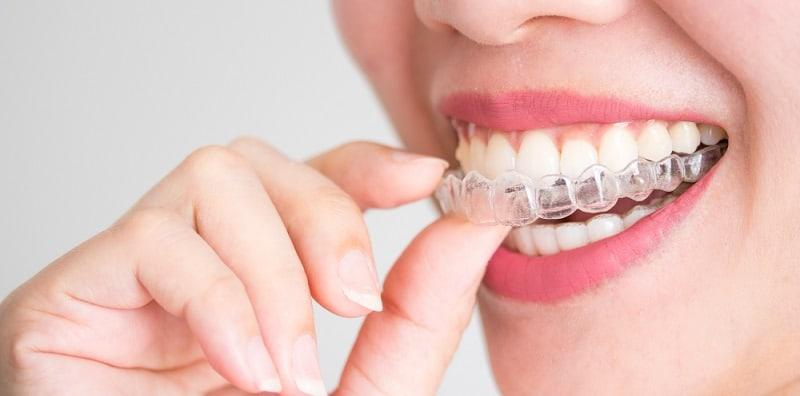 Kosmetik Pergigian: 5 Jenis Yang Perlu Anda Tahu