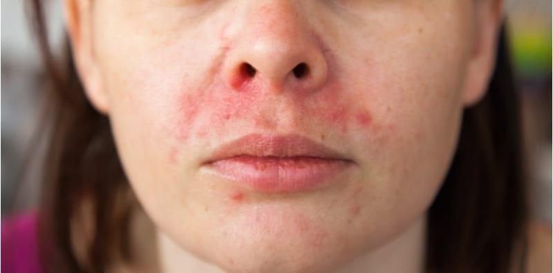 penyakit-dermatitis-perioral