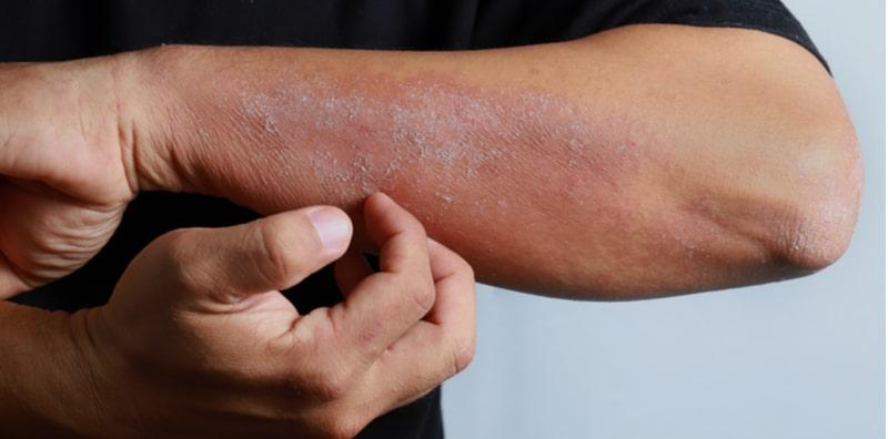 Selain Dermatitis Kontak, Ada 6 Lagi Jenis Ekzema Yang Boleh Dikenal Pasti!
