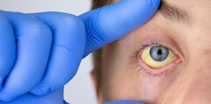 Hepatitis, Apa Tu? Kenali ABC Hepatitis Dan Pastikan Diri Sentiasa Dilindungi!