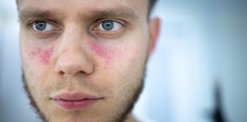 penyakit-lupus-lelaki