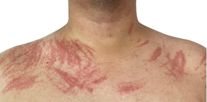 Kenali Dermatographia, Penyakit Kulit Yang Alah Dengan Sentuhan & Tekanan
