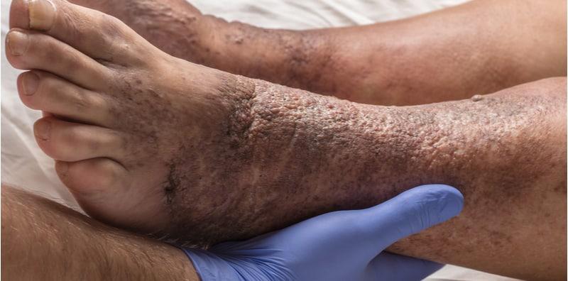 Masalah Kulit Kaki Merekah, Bengkak & Gatal-gatal, Ini Namanya Penyakit Ekzema Kaki!