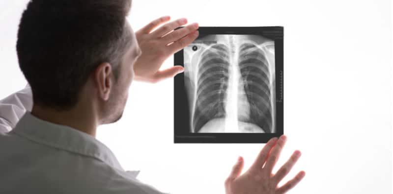 granuloma-paru-adalah