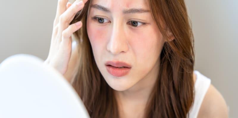 petua-hilangkan-sunburn-cepat