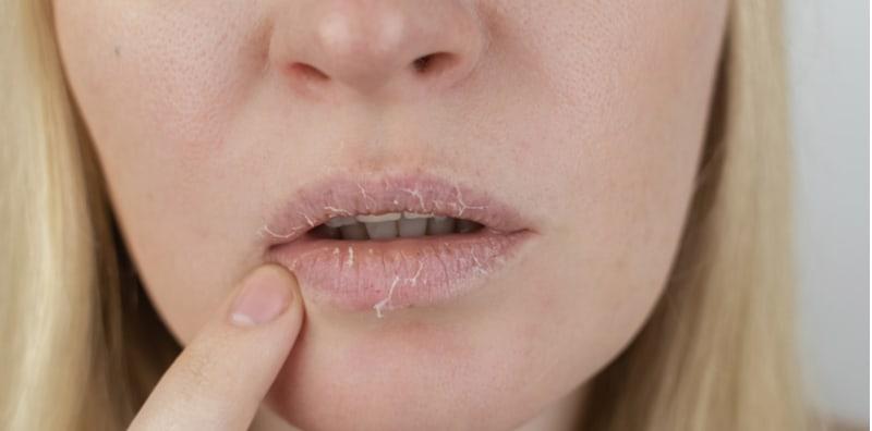 Bibir Kering & Berkeruping Selepas Pakai Gincu Baharu? Ini Petanda Dermatitis Bibir!