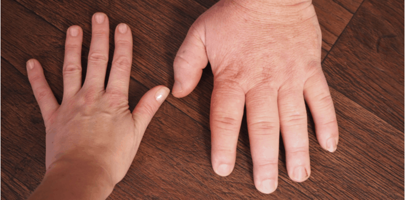 penyakit-hormon-akromegali