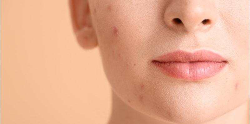 Jerawat Dah Surut, Tapi Kena Hadap Kesan Parut Pula! Ini Cara PANTAS Hilangkan Parut Akne