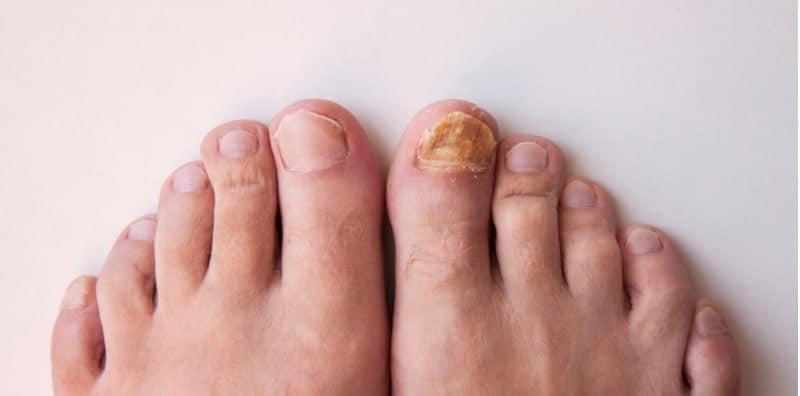 gejala-kencing-manis-kulat