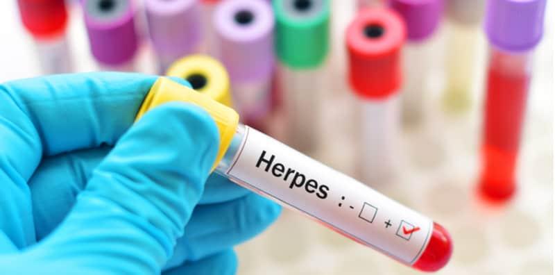 Anda Diserang Jangkitan Herpes? Cuba Remedi Natural Ini, Dapat Bantu Kawal Gejala!