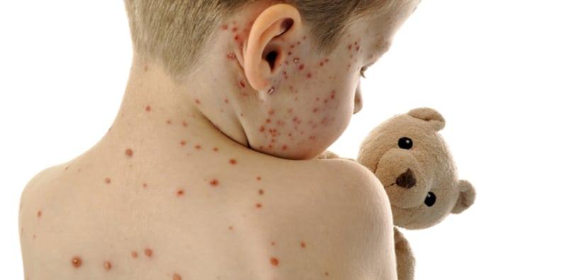 Si Kecil Kena Chickenpox? Ibu Boleh Cuba Tip Ini Agar Anak Lebih Selesa