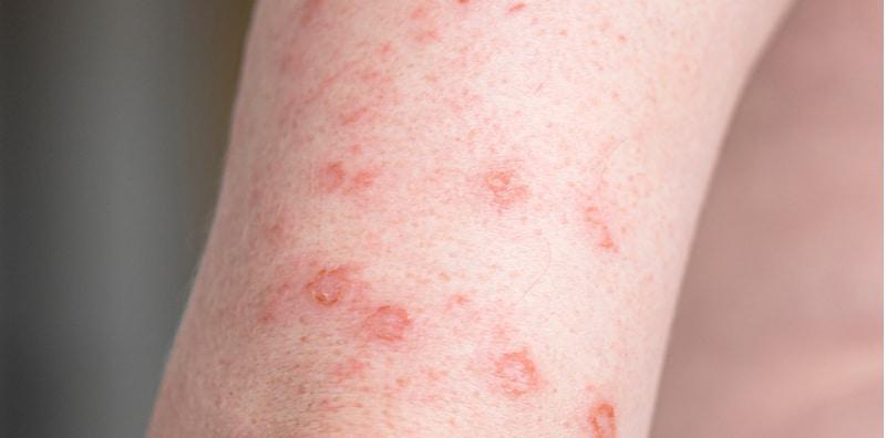 Ruam Tiba-tiba Tumbuh Di Badan? AWAS! Itu Mungkin Petanda Jangkitan HIV