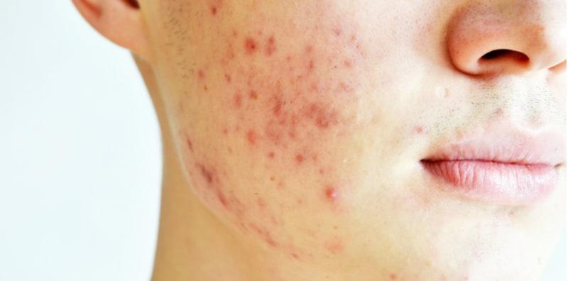 Jerawat Batu Di Pipi.. Aduh Sakitnya! Cuba Rawatan Efektif Ini, Jangan Main Picit Saja!