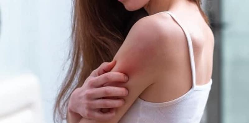 apa-itu-dermatitis-atopik