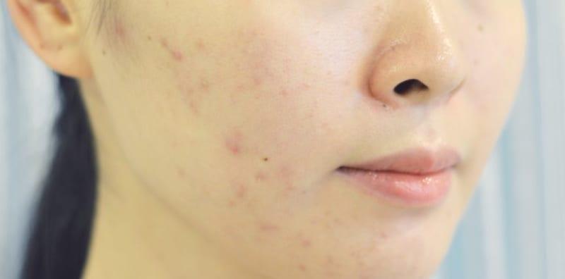jerawat-nanah-vs-jerawat-biasa