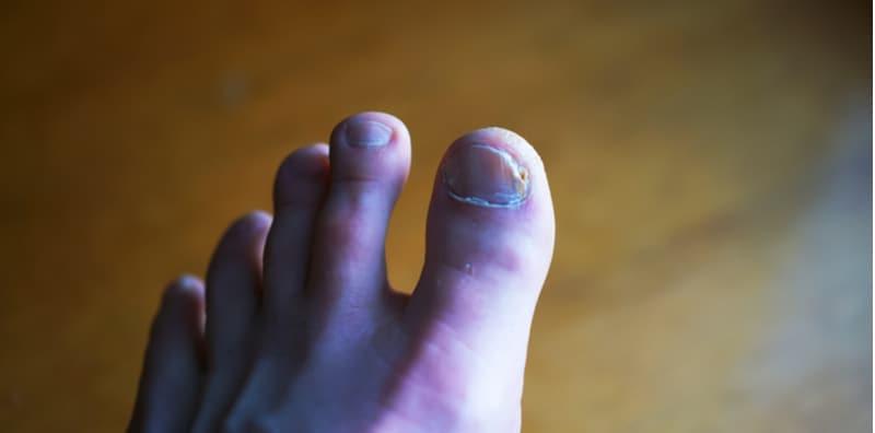 Hairan Tengok Kuku Jadi Warna Biru, Rupanya Ia Juga Petanda 3 Penyakit Ini!