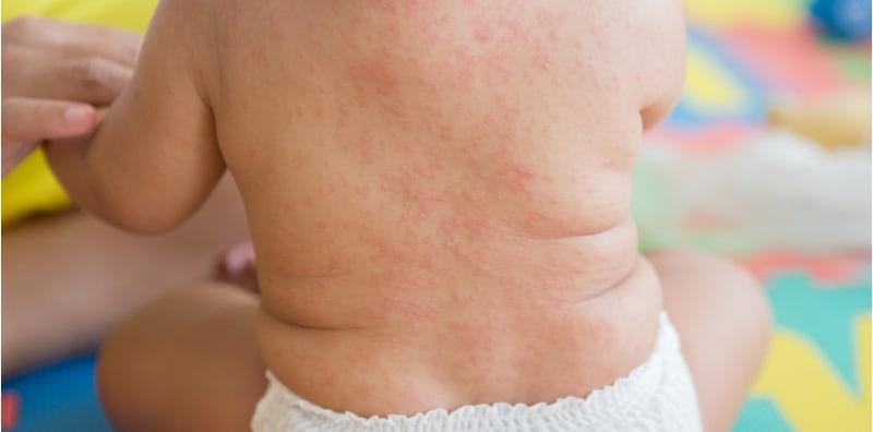Rubella Boleh BERJANGKIT, Ibu Kena Pantau Simptom Ini Pada Si Kecil