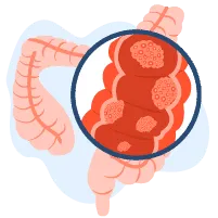 Ujian Risiko Kanser Kolorektal
