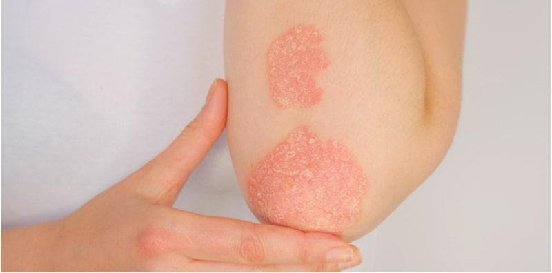 Cegah Psoriasis Daripada Meradang Dan Gatal, Cuba 4 Cara Ini!