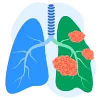 Ujian Risiko Kanser Paru-paru