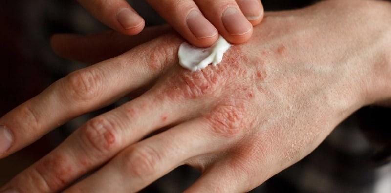 Kulit Gatal-Gatal Sampai Ada Biji-Biji Kecil? Jangan Garu! Ia Mungkin Penyakit Dishidrosis