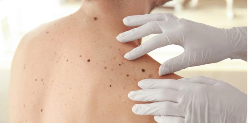 tanda-tanda-kanser-kulit