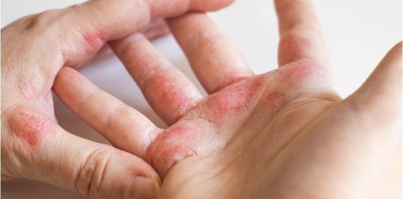 makanan-untuk-ekzema