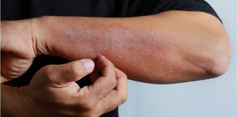 Ada Masalah Kulit Bersisik Macam Ikan? Ini Cara Uruskan Dan Merawatnya