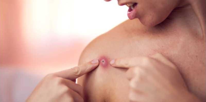 Rawat Bisul Di Kulit Dengan Ubat Antibiotik, Adakah Cara Ini Benar Efektif?