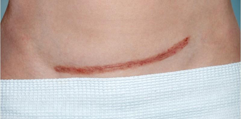 bersalin-secara-pembedahan