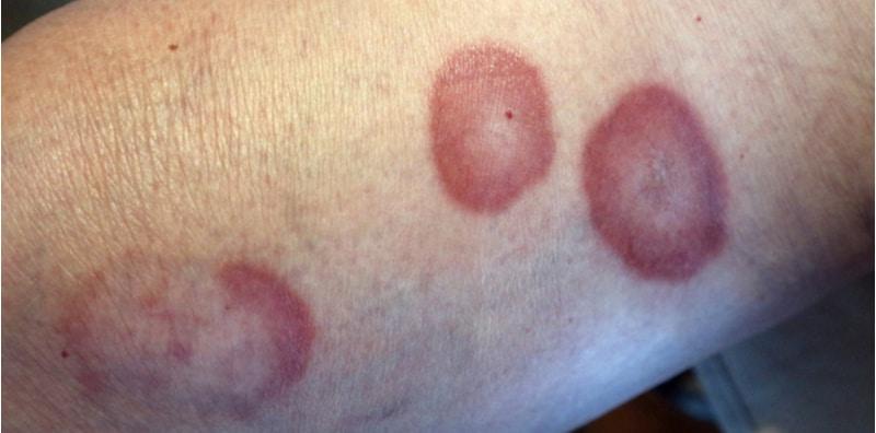 gangguan-pada-kulit-diabetes