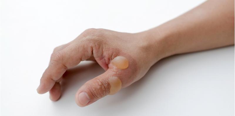 gelembung-air-pada-jari-tangan