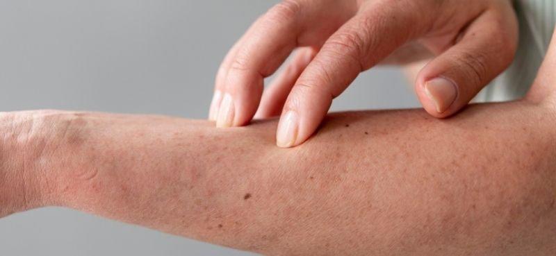 Kulit Muka Dan Tangan Sering Gatal-Gatal? Ini Mungkin Tanda Dermatitis Sentuh!