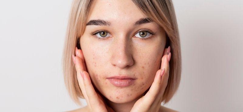 Ini 5 Tip Penjagaan Untuk Kulit Wajah Yang Kering Semasa Ramadan