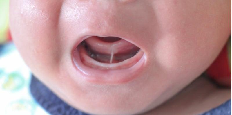 Bayi Ada Masalah Lidah Pendek? Mama, Ini 10 Cara Yang Betul Untuk Kenal Pasti!