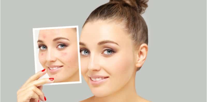 serum-untuk-hilangkan-parut-jerawat