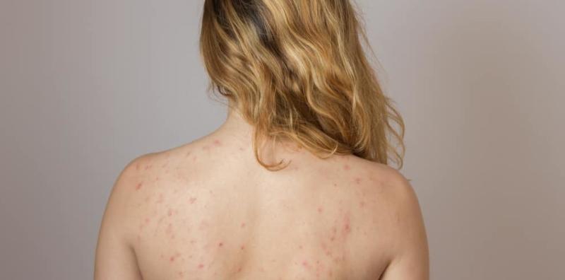 Ada Jerawat Di Belakang Badan? Ini Info Lengkap Tentangnya