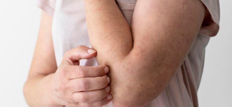 7 Makanan Sihat Untuk Bantu Pesakit Psoriasis Lawan Kegatalan!