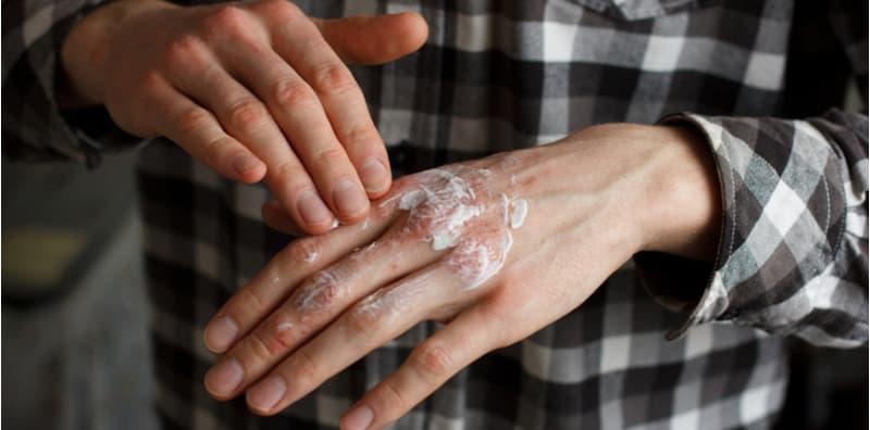 ubat-eczema-di-farmasi