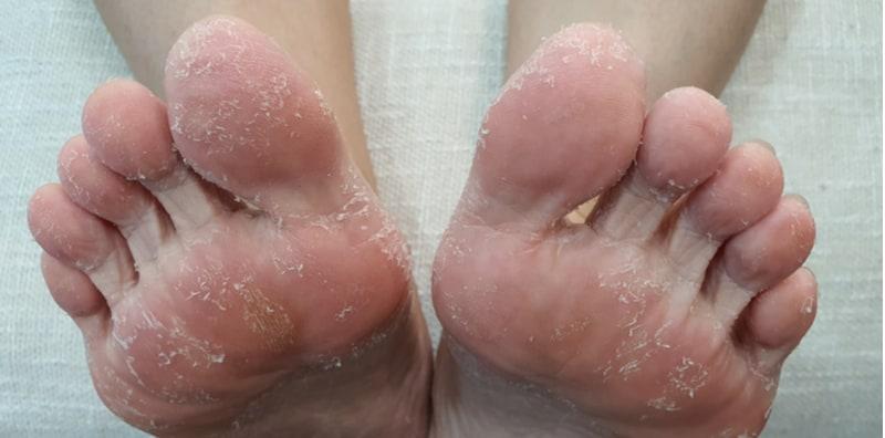 Bukan Sebab Kulit Kering Saja, Ada 5 Punca Utama Kulit Kaki Mengelupas!