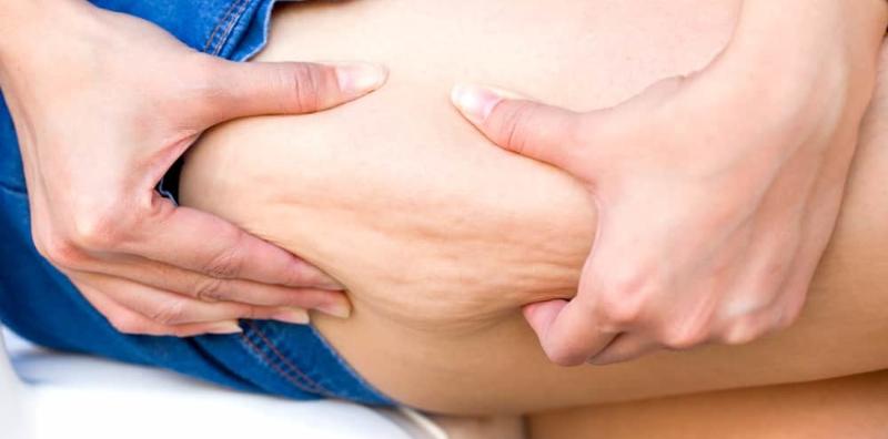 Nak Kulit Tubuh Bawah Cantik? Cuba 5 Cara Hilangkan Selulit Di Punggung!