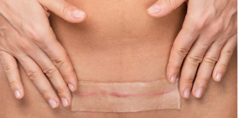 Hati-hati Mama, 4 Perkara Ini Boleh Jadi Sebab Luka Czer Terbuka Kembali!