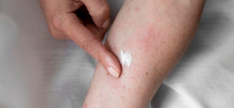 jenis-jenis-penyakit-kulit