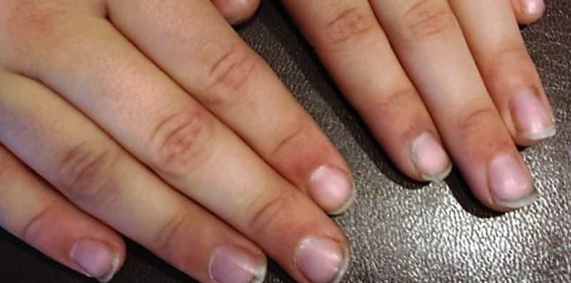 penyakit-yang-berpunca-daripada-kuku-yang-kotor