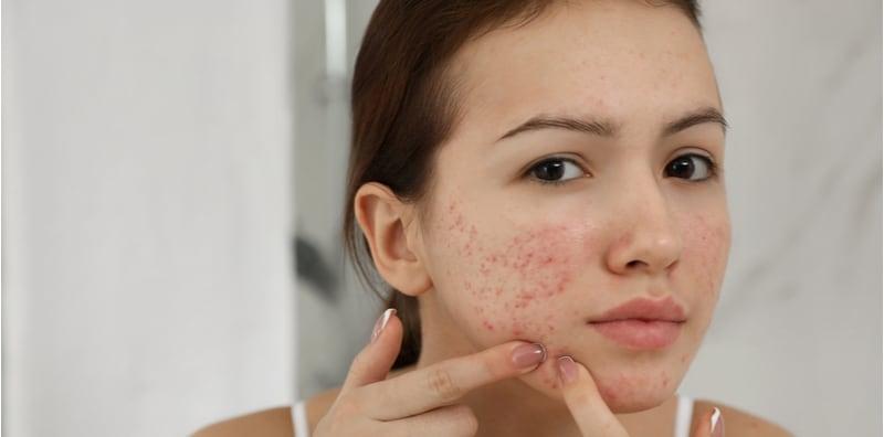Ada Masalah Jerawat Teruk? Solusinya, Ambil Pil Perancang! Betul Ke Berkesan?