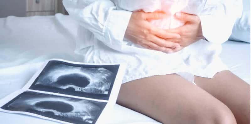 5 Mitos Dan Fakta Tentang Cyst Ovari Wanita, Terungkai Dalam Artikel Ini!