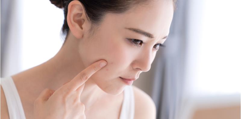 Jangan Terkejut, 15 Makanan Dan Minuman Ini Boleh Sebabkan Muka Berjerawat!