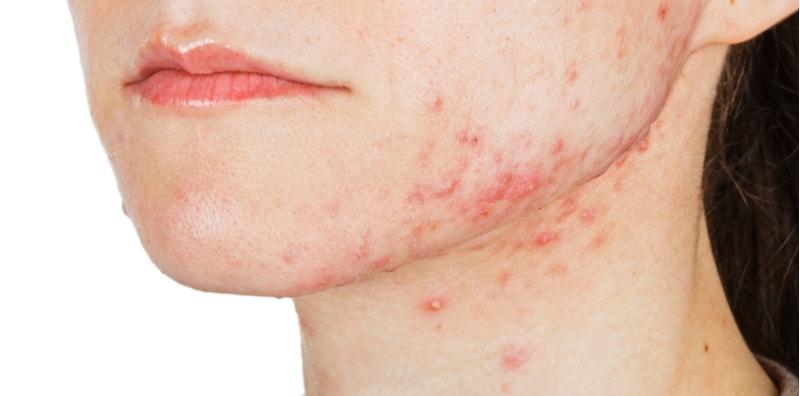 jerawat-di-dagu-rawatan